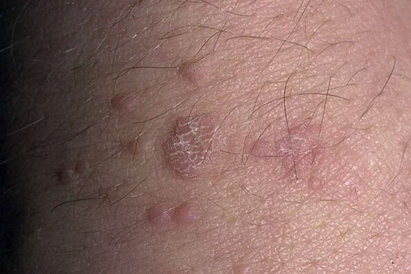 Lapos papilloma