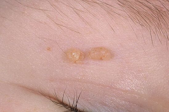 Rendes papilloma