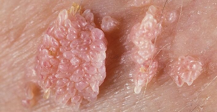 Óriási condyoma