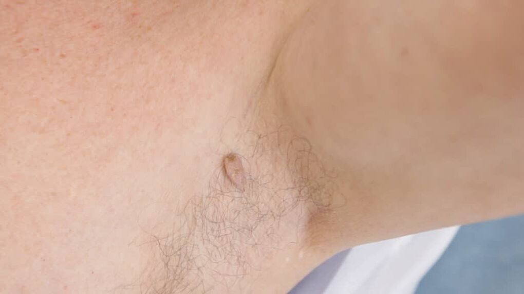 Papilloma film