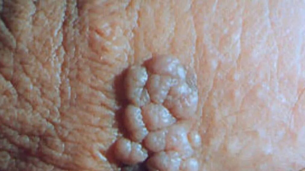 Éles condyoma