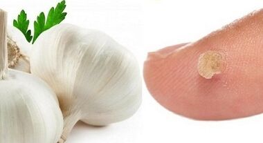 a szemölcsök kezelése népi gyógymódokkal