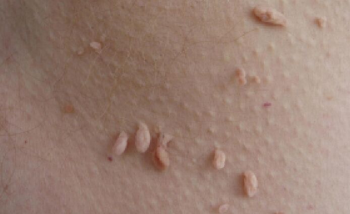 a papillómák emberi testen való megjelenésének okai