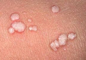 vulgáris papillómák az emberi testen