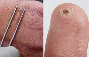 a papillómák tünetei az emberi testen